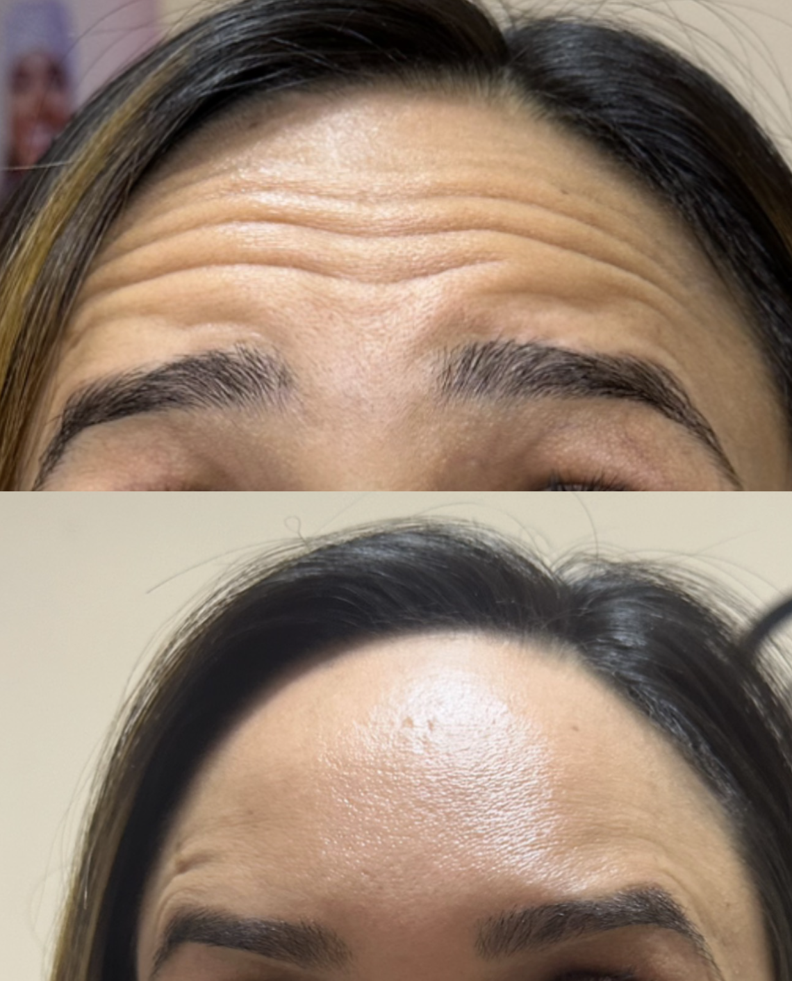 Botox