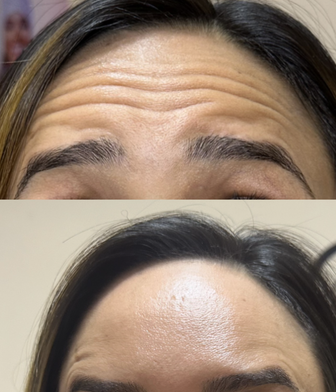 Botox